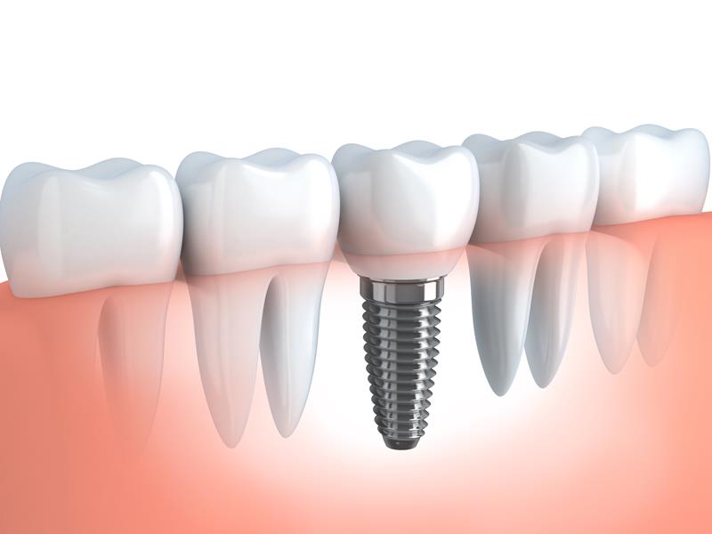 Dental Implants  Elk Grove, CA 